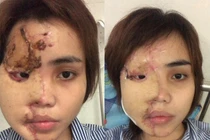 Cô gái bị thiếu uý CA tạt axit nói gì về tin “bắt cá 2 tay”?