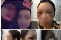 Cô dâu bị đánh bầm tím mặt vì từ chối hôn chồng trong đám cưới