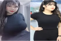 Sau khi làm phẫu thuật, nữ sinh ngực khủng Hải Dương giờ ra sao?