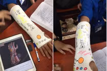 Phải bó bột, nam sinh được hội bạn thân hô biến thành Thanos