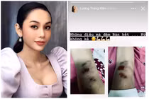 Lộ ảnh bị thương ở chân, hot girl chuyển giới khiến fan xót xa