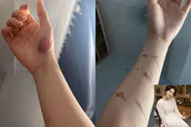 Hot girl người Tày lần đầu nói về vết thương chằng chịt trên tay