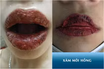 Hội chị em phun môi collagen, netizen nhìn mà chết khiếp