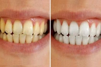 Cao răng lâu năm đến mấy cũng bong ra từng mảng