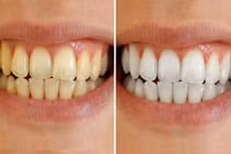 Cao răng lâu năm đến mấy cũng bong ra từng mảng