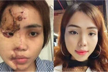 CĐM xót xa "nhan sắc" cô gái bị chồng sắp cưới tạt axit trước khi gặp nạn