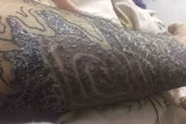 "Rợn tóc gáy" hình ảnh khách hàng bị nhiễm trùng, mưng mủ do xăm mực "dởm"