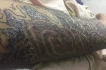 "Rợn tóc gáy" hình ảnh khách hàng bị nhiễm trùng, mưng mủ do xăm mực "dởm"