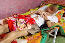 Kinh hãi người đàn ông bị hoại tử mặt ở Tiền Giang