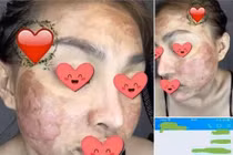 Dùng kem lột da cô gái như bỏng nặng, Trang Nemo bị réo tên