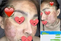 Dùng kem lột da cô gái như bỏng nặng, Trang Nemo bị réo tên