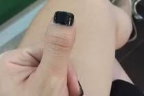 Dân mạng thi nhau khoe ảnh ngón tay cái cụt ngủn kỳ dị