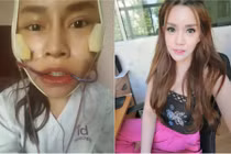 Hot girl Thái khoe ảnh phẫu thuật thẩm mỹ gớm ghiếc
