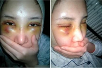 Cô gái “băm nát mặt” phẫu thuật thẩm mỹ cho giống Angela Baby