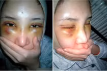 Cô gái “băm nát mặt” phẫu thuật thẩm mỹ cho giống Angela Baby