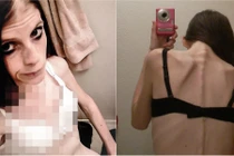 Thi giảm cân, cô gái Mỹ biến mình thành "bộ xương khô"