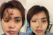 Hành trình đau đớn tìm lại nhan sắc của cô gái bị chồng sắp cưới tạt axit