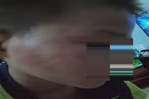 Học sinh tiểu học bị thầy giáo tát tím mặt vì không ngủ trưa