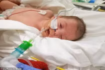 Lại là “nụ hôn thần chết” khiến bé 8 tuần tuổi đối mặt tử thần