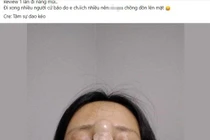 Cô gái gây hãi hùng khi nhìn thành quả của màn nâng mũi