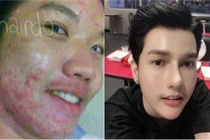 Bị bạn gái chê “mặt mụn”, chàng trai Thái quyết tâm lột xác 