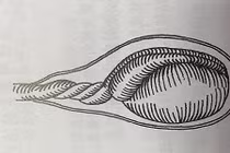 Cậu bé phải cắt bỏ tinh hoàn do bị xoắn