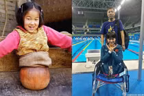 "Cô bé bóng rổ" mất nửa cơ thể ngày ấy giờ ra sao?