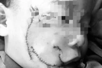 Nghệ An: Đau lòng bé 3 tuổi bị chó nhà tấn công vùng mặt