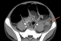 Vào viện vì đau bụng, trẻ 15 tuổi được chẩn đoán mắc ung thư