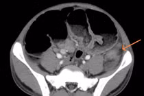 Vào viện vì đau bụng, trẻ 15 tuổi được chẩn đoán mắc ung thư