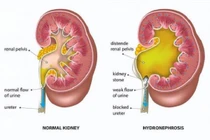 Thay đổi “sớm” 4 thói quen để tránh xa nhiễm độc niệu