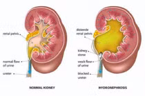 Thay đổi “sớm” 4 thói quen để tránh xa nhiễm độc niệu