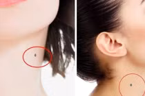 Nốt ruồi ở cổ: 2 vị trí giàu sang, 3 vị trí khổ trăm bề