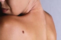 Những người có 4 nốt ruồi tiền tài kém, cả đời vất vả bôn ba