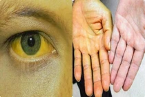 Dấu hiệu 2 vàng - 1 đỏ cảnh báo gan đang suy kiệt... nên đi khám ngay