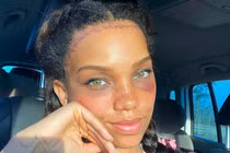 Cô gái chi tiền khủng để phẫu thuật che giấu vầng trán “sân bay”