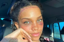 Cô gái chi tiền khủng để phẫu thuật che giấu vầng trán “sân bay”