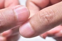 Bàn tay xuất hiện 5 dấu hiệu này chứng tỏ mắc bệnh gan