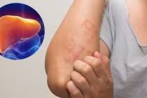 Nữ giáo viên 29t mắc bệnh gan, qua đời: BS cảnh báo 2 thói quen tai hại