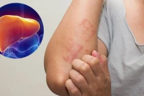 Nữ giáo viên 29t mắc bệnh gan, qua đời: BS cảnh báo 2 thói quen tai hại