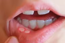 Thường xuyên viêm loét miệng không thể chủ quan, có thể dẫn tới ung thư