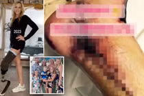 Bà mẹ 5 con bị mất chân sau khi nhiễm bọ ăn thịt