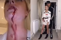 Bạn gái siêu sao Manchester United đăng video bị bạo hành máu me bầm tím