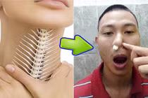 Video: Mẹo chữa hóc xương cá chỉ... 1 phút 30 giây 