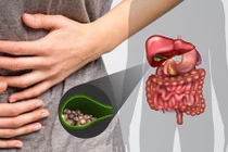 Video: Cắt túi mật ảnh hưởng thế nào đến sức khỏe của bạn?