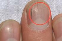 Video: Nhận biết gan nhiễm độc qua 3 dấu hiệu bất thường của móng tay