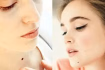 Video: Chỉ cần xóa nốt ruồi này tài lộc đầy nhà, giàu sang ập tới