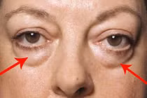 Video: Nguyên nhân nhiều người có “túi mỡ” dưới mắt