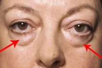 Video: Nguyên nhân nhiều người có “túi mỡ” dưới mắt