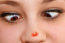 Video: Mụn mọc vị trí này, chắc chắn 100% đang có bệnh nặng